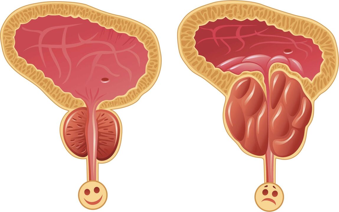 Razones para el desarrollo de prostatitis. 