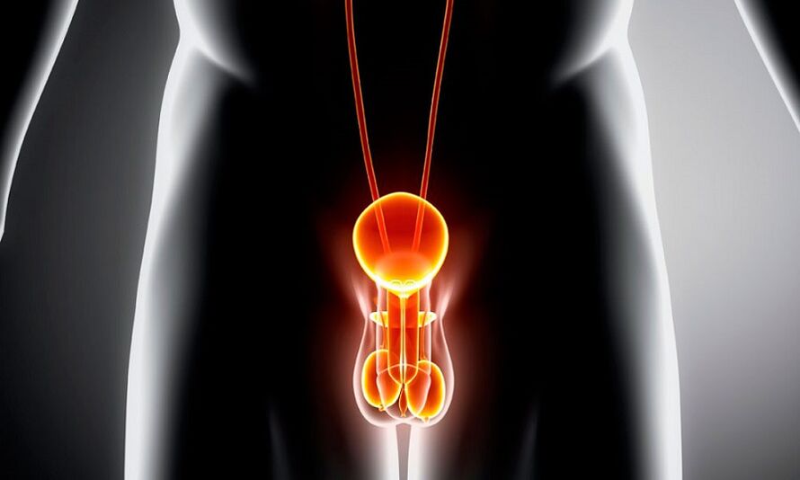 Geniturina inflamada para la prostatitis
